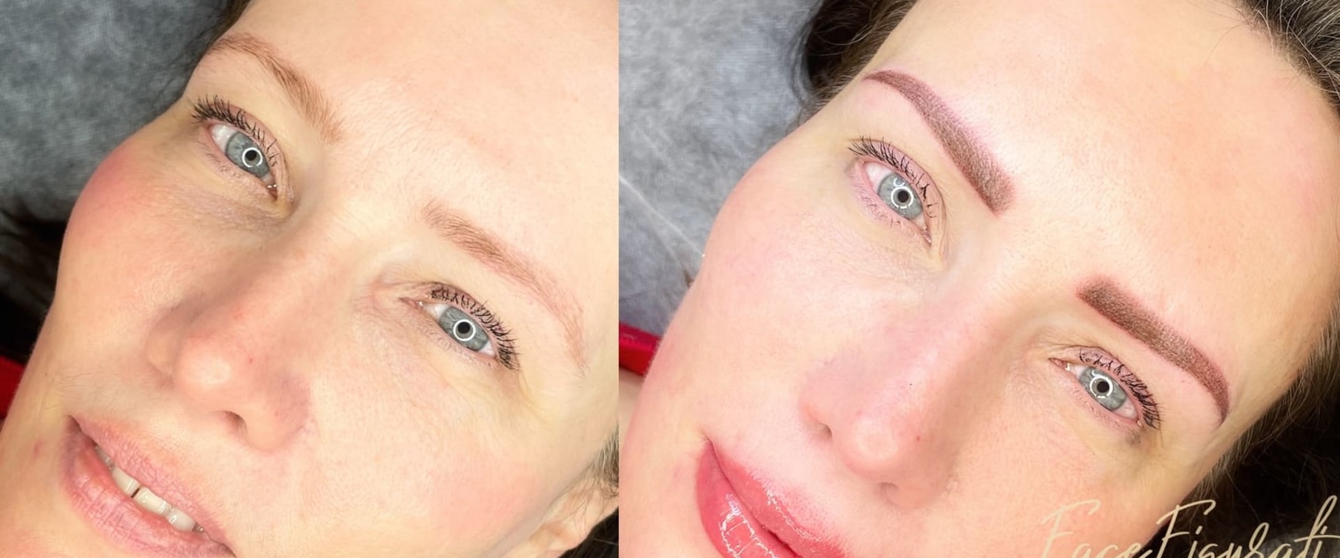 The Revolutionary Method of Tattoo Removal with Saline