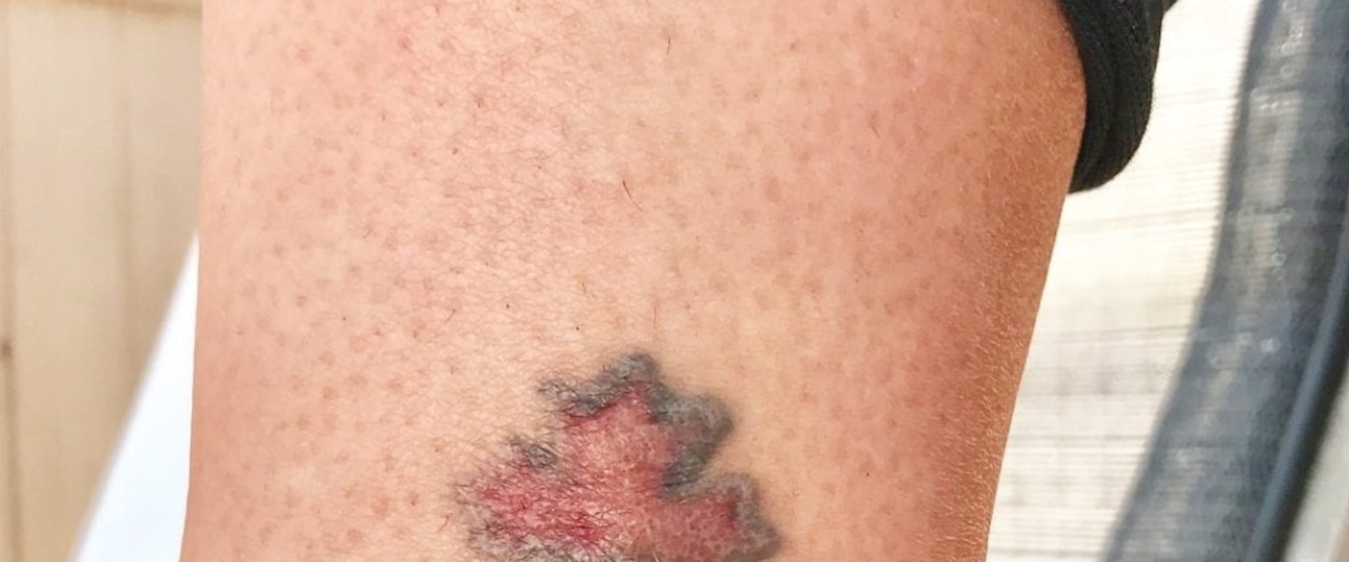 The Advantages of Saline Tattoo Removal