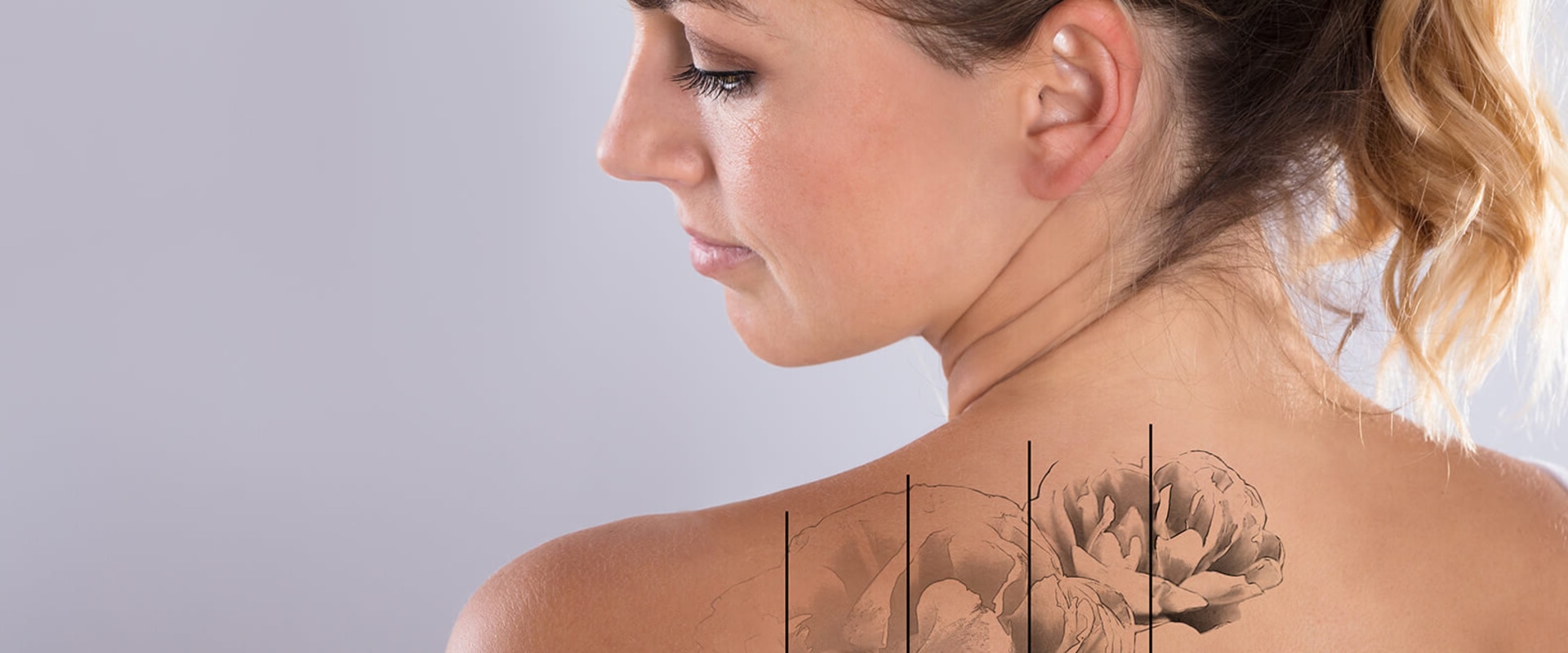Is it Safe to Get a Tattoo Over an Area Treated with Saline for Removal? An Expert's Perspective