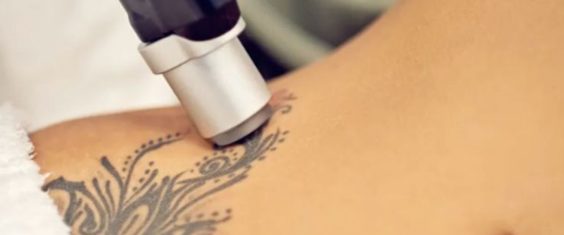 Tattoo Removal with Saline: A Safe and Affordable Option for All Skin Types