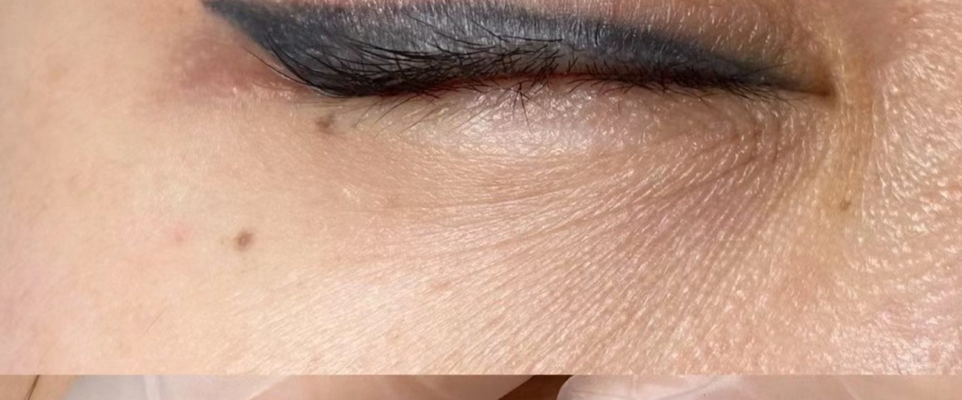 The Benefits of Saline Tattoo Removal for Sensitive Skin