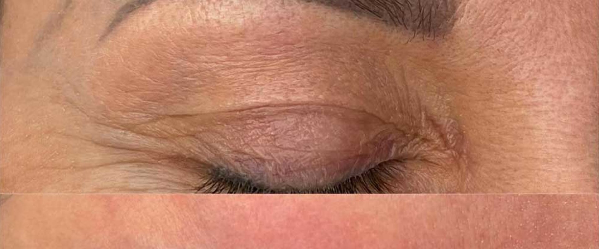 The Natural and Non-Invasive Way to Remove Tattoos: Saline Tattoo Removal