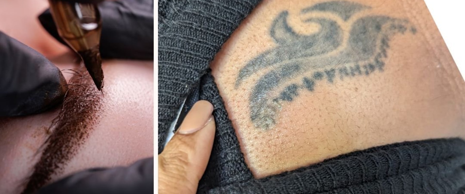 Tattoo Removal with Saline: A Comprehensive Guide