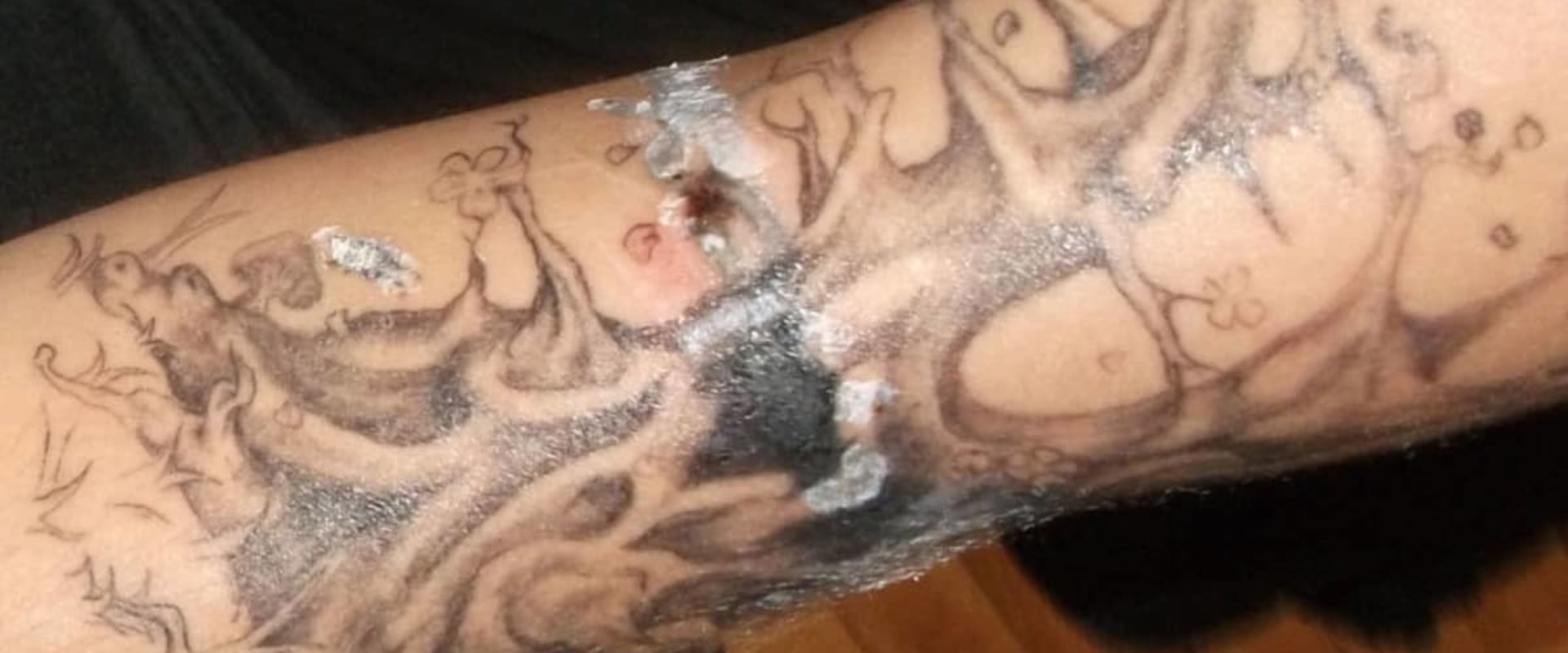 The Truth About Saline Tattoo Removal: Success Rates on Colored Tattoos