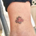 The Advantages of Saline Tattoo Removal