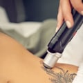 Tattoo Removal with Saline: A Safe and Affordable Option for All Skin Types