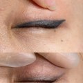 The Benefits of Saline Tattoo Removal for Sensitive Skin