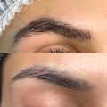 How to Achieve the Best Results with Saline Tattoo Removal