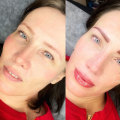 Cover-Up Tattoos Over Saline Removal: An Expert's Perspective