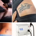 Tattoo Removal with Saline: A Comprehensive Guide