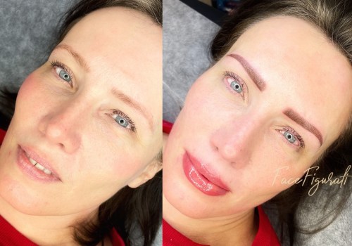 The Revolutionary Method of Tattoo Removal with Saline