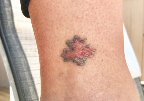 The Advantages of Saline Tattoo Removal