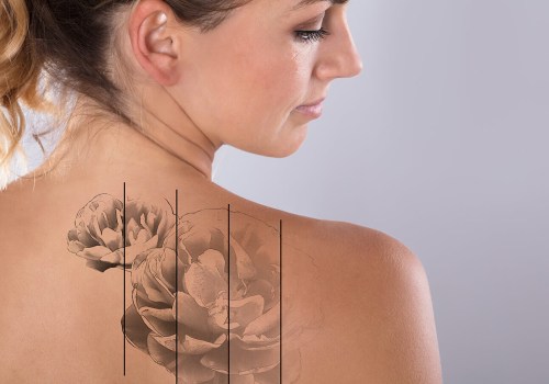 Is it Safe to Get a Tattoo Over an Area Treated with Saline for Removal? An Expert's Perspective