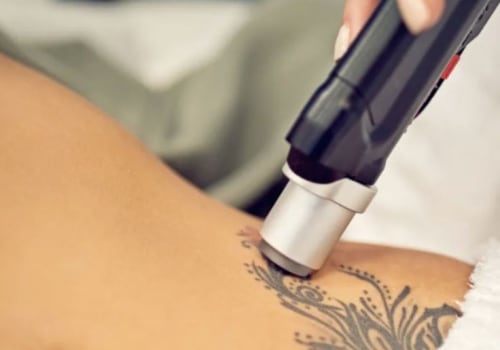 Tattoo Removal with Saline: A Safe and Affordable Option for All Skin Types