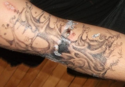 The Ins and Outs of Saline Tattoo Removal
