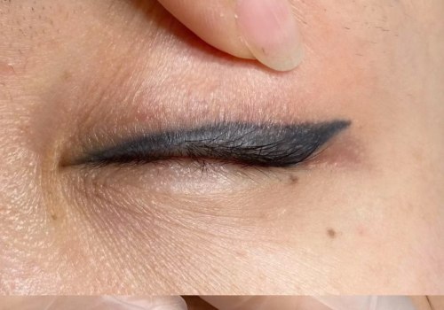 The Benefits of Saline Tattoo Removal for Sensitive Skin