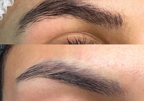 How to Achieve the Best Results with Saline Tattoo Removal