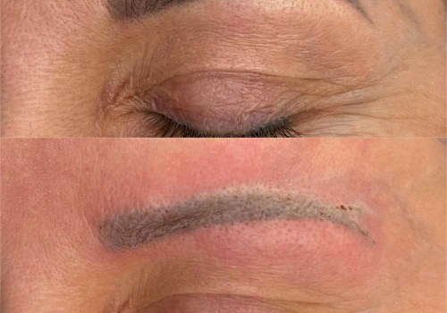 The Natural and Non-Invasive Way to Remove Tattoos: Saline Tattoo Removal