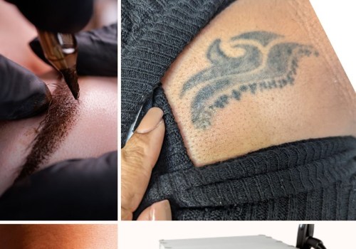 Tattoo Removal with Saline: A Comprehensive Guide